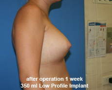 plastic-surgery-breast-augmentation